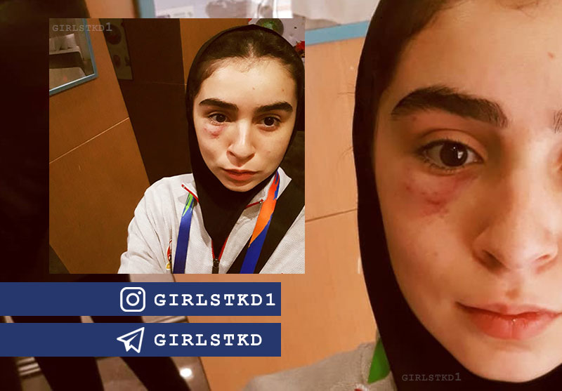 مشت تکواندوکار ازبک روی صورت کوثر اساسه : سند ایستادگی “صورت زخمی”